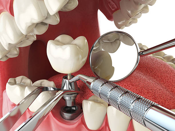 Best Emergency Dental Extractions in Knollwood, IL
